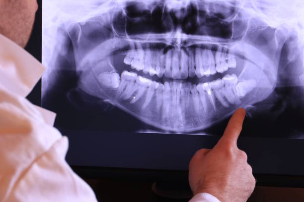 Best Emergency Wisdom Teeth Removal in Huntsville, AL