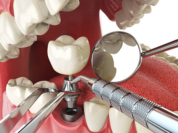 Best Emergency Broken Tooth Repair in Huntsville, AL